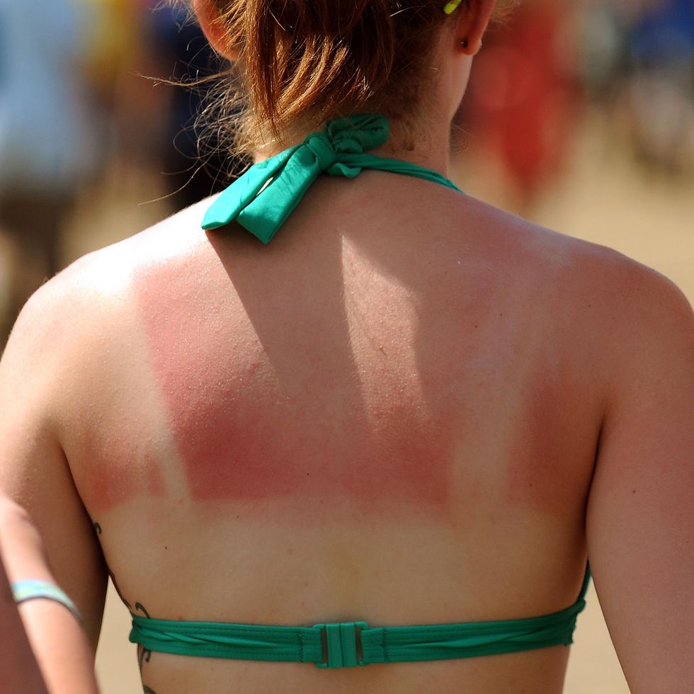 woman-suffers-from-sunburn-during-the-2009-glastonbury-news-photo-1591737545.jpg